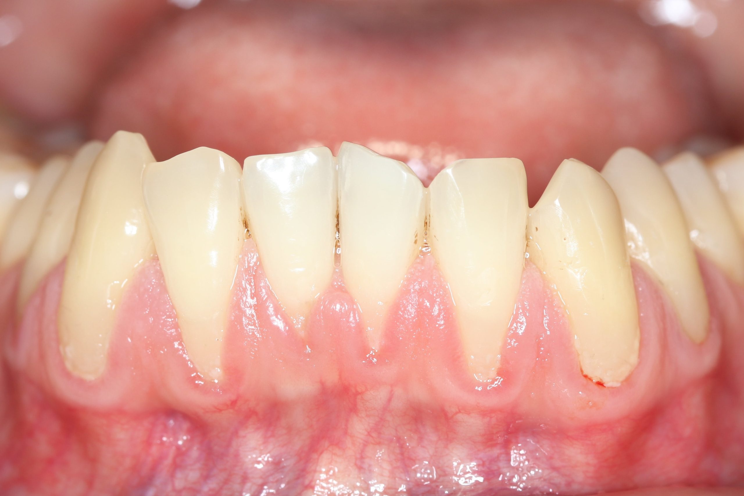 The Truth About Gum Recession Treatments: What Patients Need to Know