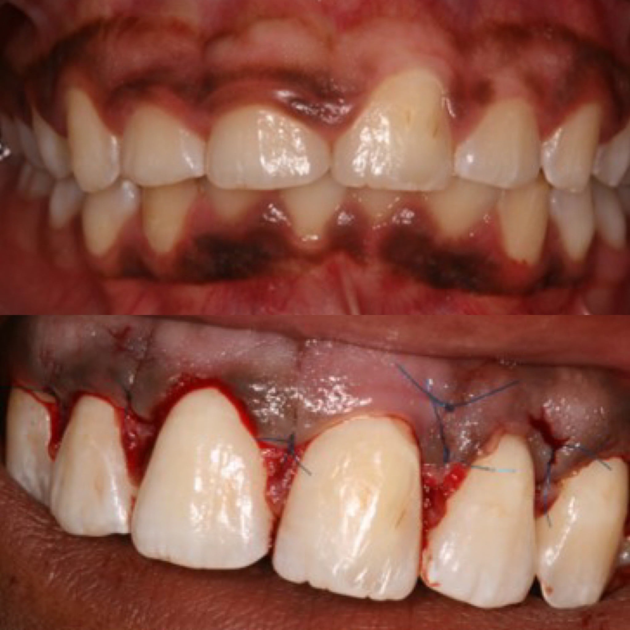 Crown Lengthening Surgery: Revealing the Concealed Splendour of Your Smile!