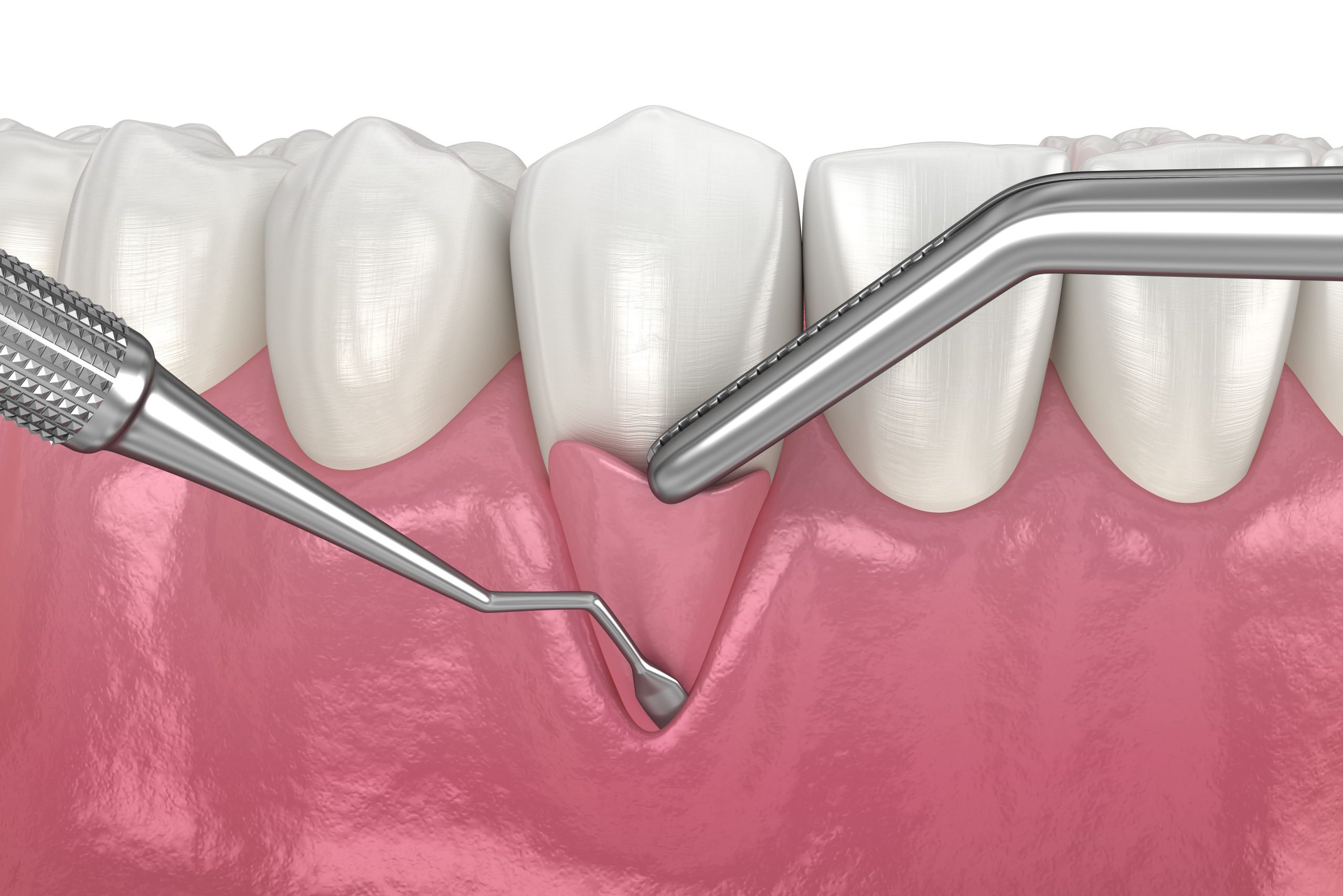 Autograft vs. Allograft for Gum Grafting: Which Option is Best for You?