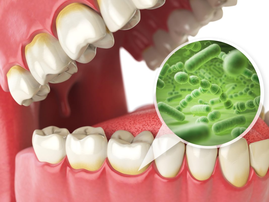 Compare non-surgical to surgical gum disease london