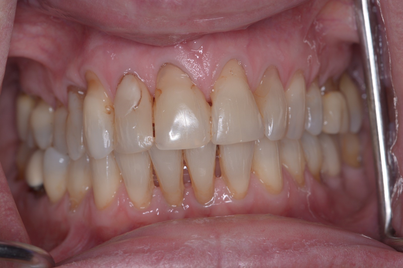 Shield Your Gingiva! 😁 The Paramount Compendium on Gum Recession: Genesis, Interventions & Tactics to Avert It